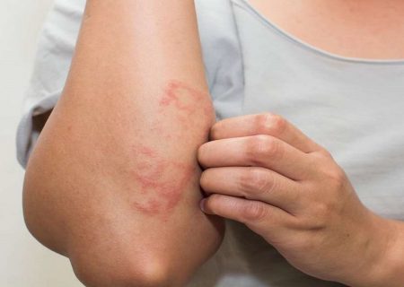 قرمزی پوست از علائم کروناست؟
