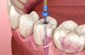 دندان عصب کشی شده چه مدت زنده می ماند؟